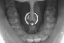 sublingual